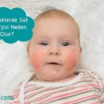 Bebeklerde Süt Alerjisi Neden Olur?